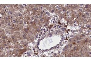 ABIN6273966 at 1/100 staining Human liver cancer tissue by IHC-P. (OR1F1 antibody  (C-Term))