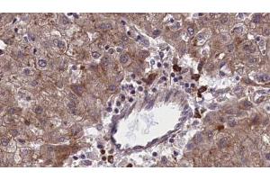 ABIN6273966 at 1/100 staining Human liver cancer tissue by IHC-P.