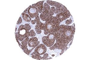Anal canal Squamous cell carcinoma with strong TRIM29 immunostaining of tumor cells (TRIM29 antibody  (AA 1-200))