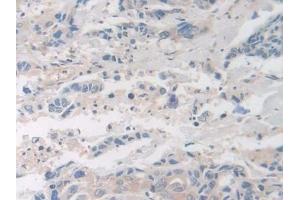 Detection of F8 in Human Breast cancer Tissue using Polyclonal Antibody to Coagulation Factor VIII (F8) (Factor VIII antibody  (AA 1887-2044))