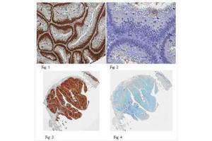 Formalin Fixed Paraffin Embedded (FFPE) human colon adenocarcinoma tissues (Fig.