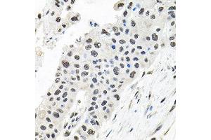 Immunohistochemistry of paraffin-embedded human lung cancer using CDCA8 antibody at dilution of 1:100 (x40 lens). (CDCA8 antibody)