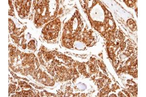 IHC-P Image Immunohistochemical analysis of paraffin-embedded human tyroid cancer, using PPP2R5D, antibody at 1:100 dilution. (PPP2R5D antibody  (C-Term))