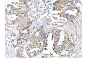 The image on the left is immunohistochemistry of paraffin-embedded Human cervical cancer tissue using ABIN7192539(SLC9A9 Antibody) at dilution 1/45, on the right is treated with synthetic peptide. (SLC9A9 antibody)