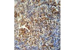 Immunohistochemistry analysis in formalin fixed and paraffin embedded human lung carcinoma reacted with MAF1 Antibody (Center) followed which was peroxidase conjugated to the secondary antibody and followed by DAB staining. (MAF1 antibody  (Middle Region))