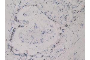 DAB staining on IHC-P; Samples: Human Bile duct cancer Tissue (SHBG antibody  (AA 51-218))