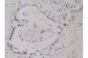 DAB staining on IHC-P; Samples: Human Bile duct cancer Tissue