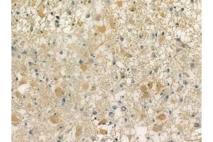 ABIN6256683 and ABIN6267165 at 1/100 staining human astrocytoma by IHC-P.