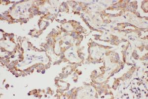Anti-Galectin 3 Picoband antibody,  IHC(P): Human Lung Cancer Tissue (Galectin 3 antibody  (AA 139-250))