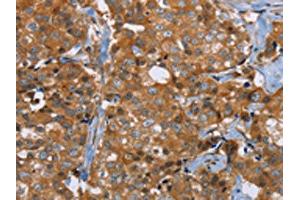 The image on the left is immunohistochemistry of paraffin-embedded Human breast cancer tissue using ABIN7191755(P2RY1 Antibody) at dilution 1/40, on the right is treated with synthetic peptide. (P2RY1 antibody)