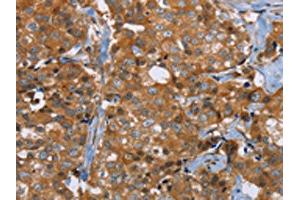 The image on the left is immunohistochemistry of paraffin-embedded Human breast cancer tissue using ABIN7191755(P2RY1 Antibody) at dilution 1/40, on the right is treated with synthetic peptide. (P2RY1 antibody)