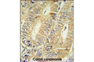 HPGD Antibody IHC analysis in formalin fixed and paraffin embedded human colon carcinoma followed by peroxidase conjugation of the secondary antibody and DAB staining. (HPGD antibody  (C-Term))