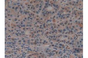 IHC-P analysis of Human Liver Cancer Tissue, with DAB staining. (PTF1A antibody  (AA 177-328))