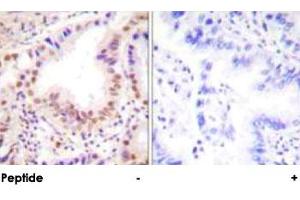 Immunohistochemical analysis of paraffin-embedded human lung carcinoma tissue using ETS1 polyclonal antibody . (ETS1 antibody)