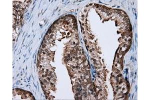 Immunohistochemical staining of paraffin-embedded Carcinoma of liver tissue using anti-RALBP1 mouse monoclonal antibody.