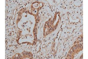 ABIN6268858 at 1/50 staining human colon cancer tissue sections by IHC-P. (MCL-1 antibody  (Internal Region))