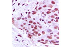 Immunohistochemical analysis of MCM2 staining in human breast cancer formalin fixed paraffin embedded tissue section.