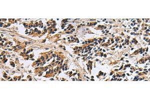 Immunohistochemistry of paraffin-embedded Human breast cancer tissue using DIAPH2 Polyclonal Antibody at dilution of 1:55(x200)