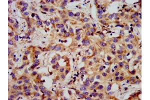 IHC image of ABIN7153315 diluted at 1:300 and staining in paraffin-embedded human liver cancer performed on a Leica BondTM system. (G Protein-Coupled Receptor 1 antibody  (AA 308-355))
