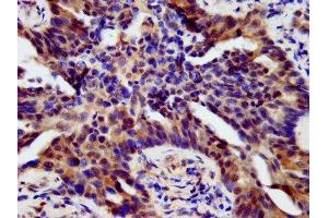 IHC image of ABIN7155739 diluted at 1:500 and staining in paraffin-embedded human lung cancer performed on a Leica BondTM system. (HOXB4 antibody  (AA 88-166))