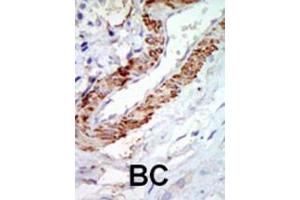 Formalin-fixed and paraffin-embedded human cancer tissue reacted with the primary antibody, which was peroxidase-conjugated to the secondary antibody, followed by DAB staining. (MAP3K8 antibody  (C-Term))