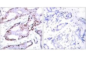 Immunohistochemistry analysis of paraffin-embedded human breast carcinoma tissue, using c-Jun (Ab-73) Antibody. (C-JUN antibody  (AA 40-89))