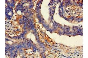 Immunohistochemistry of paraffin-embedded human colon cancer using ABIN7158800 at dilution of 1:100