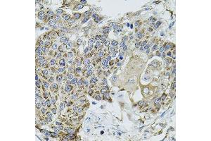 Immunohistochemistry of paraffin-embedded human lung cancer using VEPH1 antibody. (VEPH1 antibody  (AA 448-547))