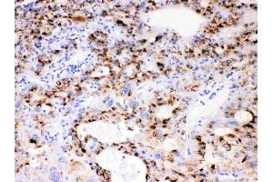 CYP3A4 was detected in paraffin-embedded sections of human liver cancer tissues using rabbit anti- CYP3A4 Antigen Affinity purified polyclonal antibody (Catalog # ) at 1 µg/mL. (CYP3A4 antibody  (Middle Region))