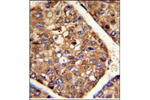 AP17615PU-N P4HB antibody staining of Formalin-Fixed and paraffin-Embedded Human hepatocarcinoma using peroxidase-conjugated to the secondary antibody, followed by DAB staining. (P4HB antibody  (C-Term))
