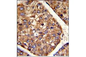 AP17615PU-N P4HB antibody staining of Formalin-Fixed and paraffin-Embedded Human hepatocarcinoma using peroxidase-conjugated to the secondary antibody, followed by DAB staining. (P4HB antibody  (C-Term))
