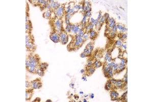 Immunohistochemistry of paraffin-embedded human liver cancer using GLUD2 antibody. (GLUD2 antibody  (AA 319-558))