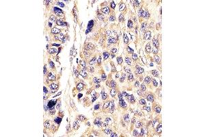 (ABIN390393 and ABIN2840785) staining AGXT in Human hepatic carcinoma tissue sections by Immunohistochemistry (IHC-P - paraformaldehyde-fixed, paraffin-embedded sections). (AGXT antibody  (AA 96-125))