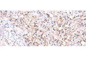 Immunohistochemistry of paraffin-embedded Human cervical cancer tissue using MANSC1 Polyclonal Antibody at dilution of 1:105(x200) (MANSC1 antibody)