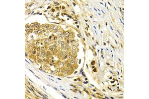 Immunohistochemistry of paraffin-embedded human esophageal cancer using CDK7 antibody (ABIN1871743) at dilution of 1:200 (40x lens). (CDK7 antibody)