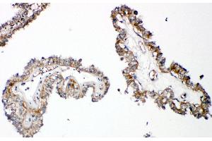 Anti-Parathyroid Hormone Receptor 1 antibody, IHC(P) IHC(P): Human Thyroid Cancer Tissue (PTH1R antibody  (C-Term))