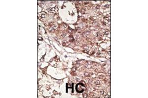 Formalin-fixed and paraffin-embedded human cancer tissue reacted with the primary antibody, which was peroxidase-conjugated to the secondary antibody, followed by DAB staining.