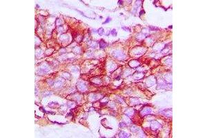Immunohistochemical analysis of IFNGR1 staining in human breast cancer formalin fixed paraffin embedded tissue section.