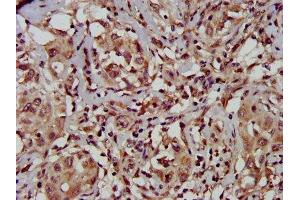 IHC image of ABIN7149946 diluted at 1:500 and staining in paraffin-embedded human liver cancer performed on a Leica BondTM system. (TFB1M antibody  (AA 59-194))