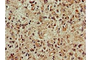 Immunohistochemistry of paraffin-embedded human glioma using ABIN7149696 at dilution of 1:100 (DCK antibody  (AA 1-79))