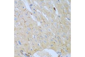 Immunohistochemistry of paraffin-embedded human liver cancer using CEACAM7 antibody (ABIN5974489) at dilution of 1/100 (40x lens). (CEACAM7 antibody)