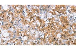 Immunohistochemistry of paraffin-embedded Human thyroid cancer tissue using MLH1 Polyclonal Antibody at dilution 1:65 (MLH1 antibody)