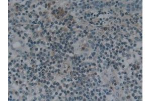 Detection of NPNT in Human Skin cancer Tissue using Polyclonal Antibody to Nephronectin (NPNT) (Nephronectin antibody  (AA 418-565))