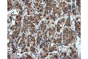Immunohistochemical staining of paraffin-embedded Carcinoma of liver tissue using anti-MSMB mouse monoclonal antibody. (MSMB antibody)