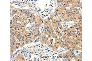 Immunohistochemistry of Human lung cancer using SLC11A2 Polyclonal Antibody at dilution of 1:65 (SLC11A2 antibody)