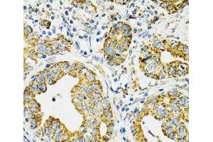 Immunohistochemistry of paraffin-embedded Human gastric cancer using HSPA9 Polyclonal Antibody at dilution of 1:100 (40x lens). (HSPA9 antibody)