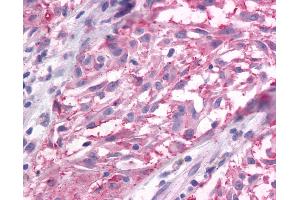 Anti-GRM3 / MGLUR3 antibody IHC of human Skin, Melanoma. (Metabotropic Glutamate Receptor 3 antibody  (N-Term))