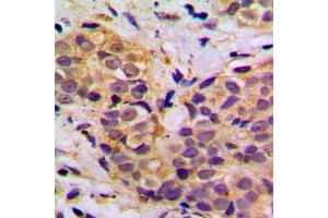 Immunohistochemical analysis of MRPL11 staining in human breast cancer formalin fixed paraffin embedded tissue section. (MRPL11 antibody  (Center))