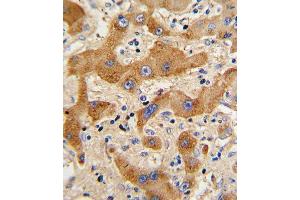 Formalin-fixed and paraffin-embedded human hepatocarcinoma reacted with GCG Antibody (N-term), which was peroxidase-conjugated to the secondary antibody, followed by DAB staining. (Glucagon antibody  (N-Term))