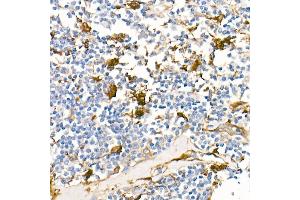 Immunohistochemistry of paraffin-embedded Human Hodgkin lymphoma using Fascin/FSCN1 antibody (ABIN7267142) at dilution of 1:100 (40x lens). (Fascin antibody)